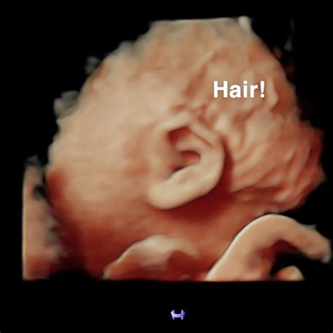 Imaging is not routinely used for the assessment of folliculitis. . Curly hair on 3d ultrasound